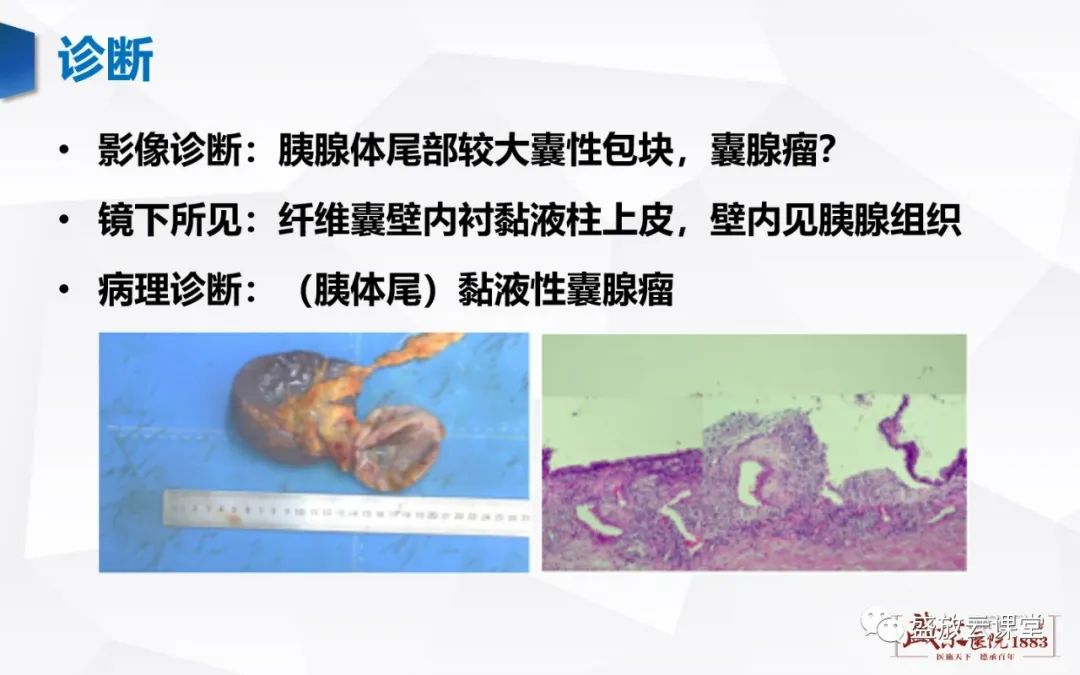 影像PPT - 【病例】胰腺囊腺瘤2例—浆液性 VS 粘液性-19 影像PPT - 【病例】胰腺囊腺瘤2例—浆液性 VS 粘液性-19