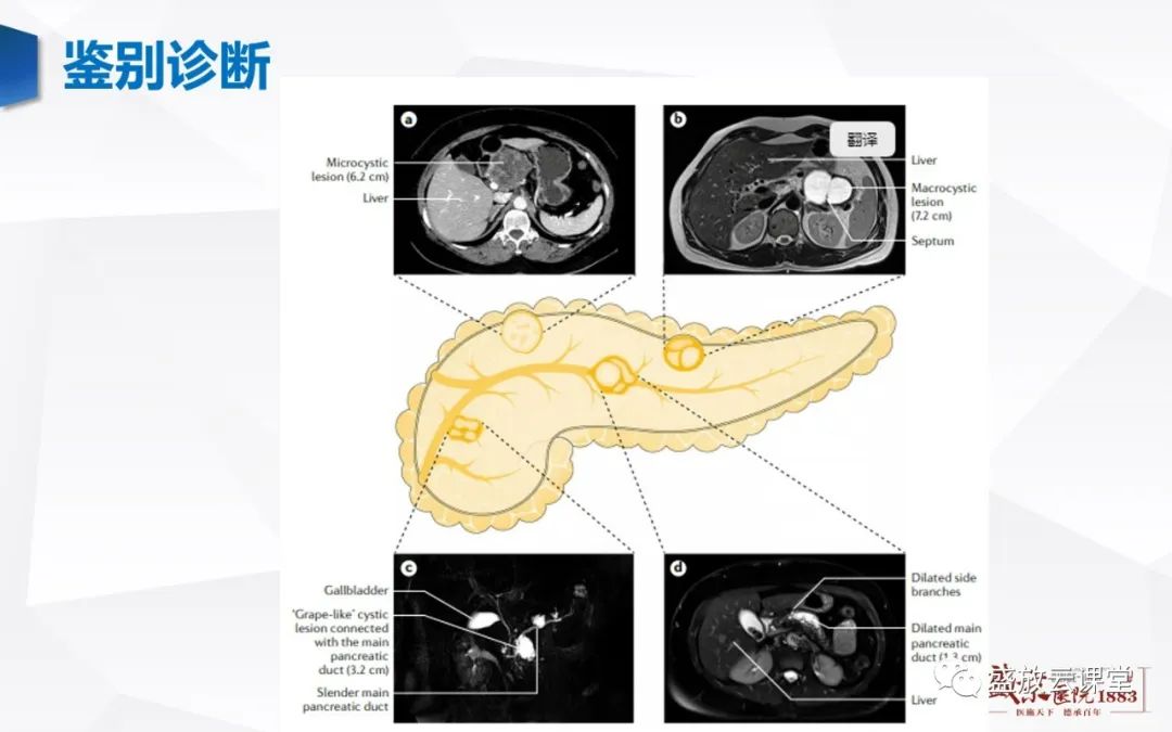 影像PPT - 【病例】胰腺囊腺瘤2例—浆液性 VS 粘液性-22 影像PPT - 【病例】胰腺囊腺瘤2例—浆液性 VS 粘液性-22