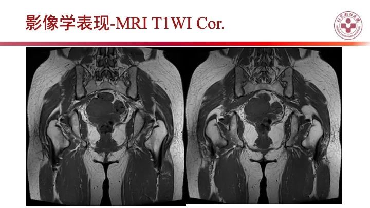 影像PPT - 【PPT】股骨坐骨撞击综合征（IFIS）-6