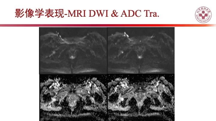 影像PPT - 【PPT】股骨坐骨撞击综合征（IFIS）-7