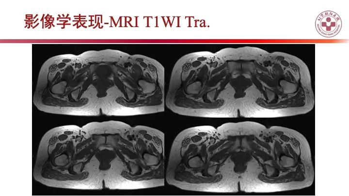 影像PPT - 【PPT】股骨坐骨撞击综合征（IFIS）-4