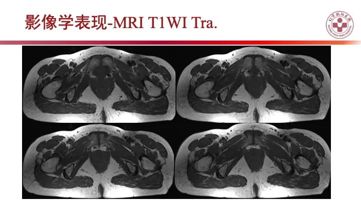 影像PPT - 【PPT】股骨坐骨撞击综合征（IFIS）-12