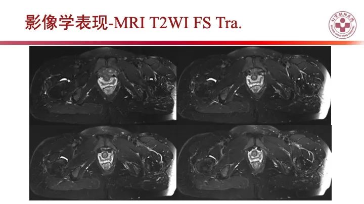 影像PPT - 【PPT】股骨坐骨撞击综合征（IFIS）-11