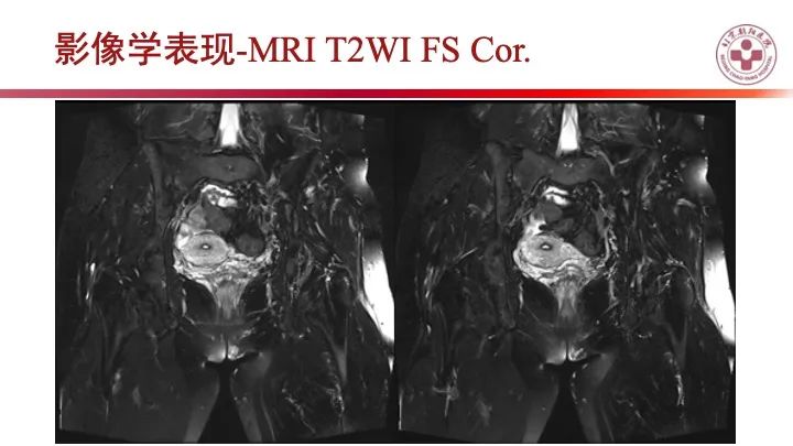 影像PPT - 【PPT】股骨坐骨撞击综合征（IFIS）-13