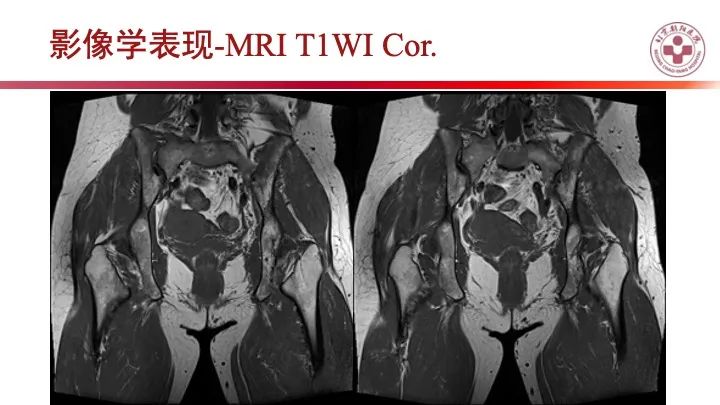 影像PPT - 【PPT】股骨坐骨撞击综合征（IFIS）-14