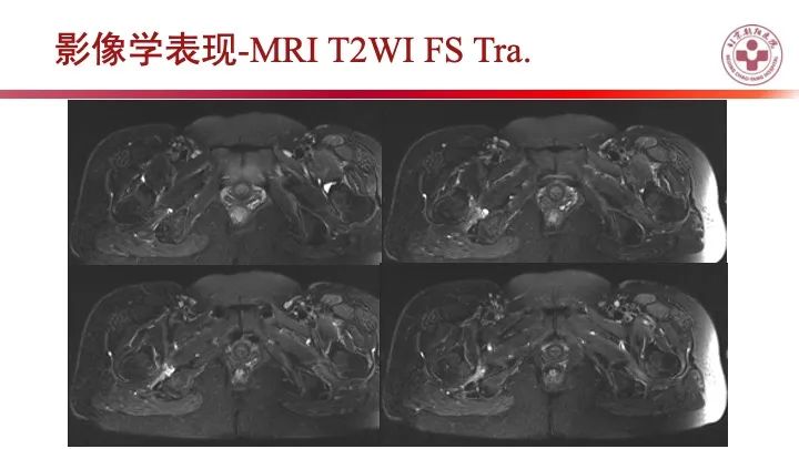 影像PPT - 【PPT】股骨坐骨撞击综合征（IFIS）-3