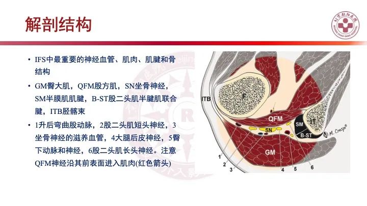 影像PPT - 【PPT】股骨坐骨撞击综合征（IFIS）-18
