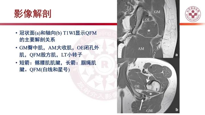 影像PPT - 【PPT】股骨坐骨撞击综合征（IFIS）-19