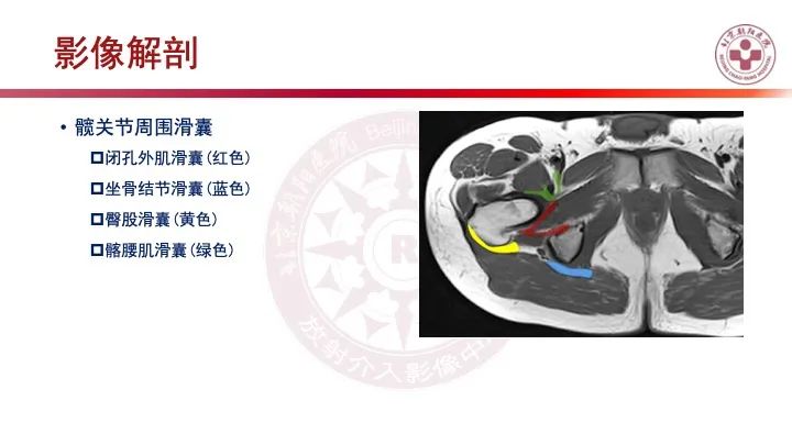 影像PPT - 【PPT】股骨坐骨撞击综合征（IFIS）-20