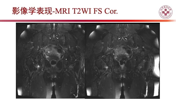影像PPT - 【PPT】股骨坐骨撞击综合征（IFIS）-5