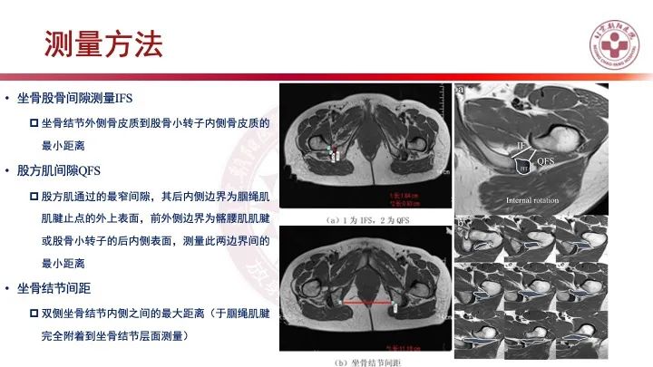 影像PPT - 【PPT】股骨坐骨撞击综合征（IFIS）-23