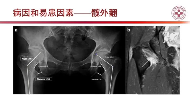 影像PPT - 【PPT】股骨坐骨撞击综合征（IFIS）-27