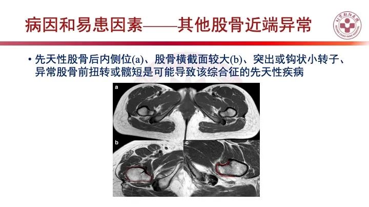 影像PPT - 【PPT】股骨坐骨撞击综合征（IFIS）-28
