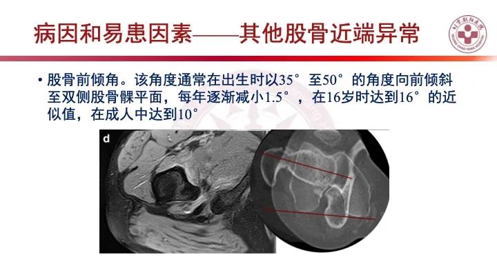 影像PPT - 【PPT】股骨坐骨撞击综合征（IFIS）-29