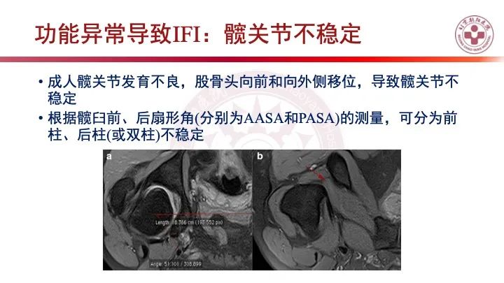 影像PPT - 【PPT】股骨坐骨撞击综合征（IFIS）-31