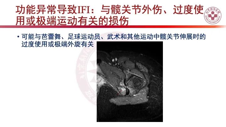 影像PPT - 【PPT】股骨坐骨撞击综合征（IFIS）-35