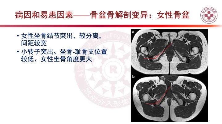 影像PPT - 【PPT】股骨坐骨撞击综合征（IFIS）-30