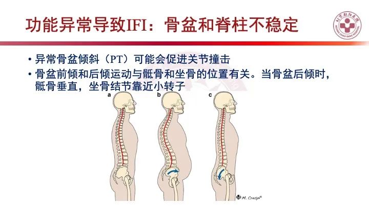 影像PPT - 【PPT】股骨坐骨撞击综合征（IFIS）-32