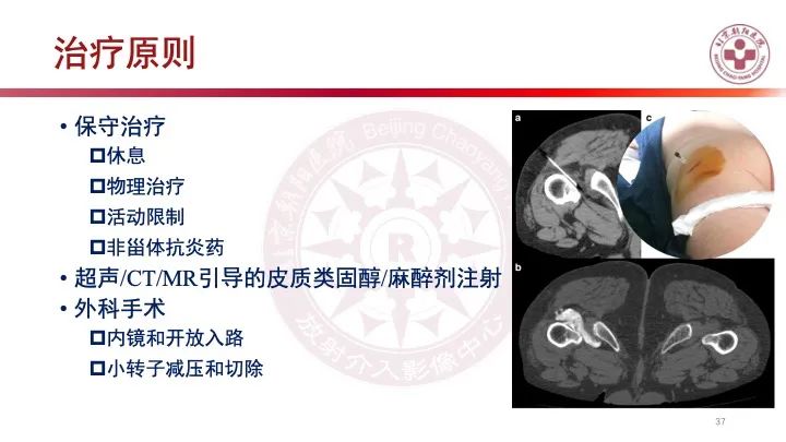 影像PPT - 【PPT】股骨坐骨撞击综合征（IFIS）-36