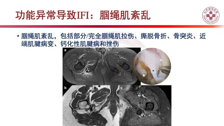 影像PPT - 【PPT】股骨坐骨撞击综合征（IFIS）-34