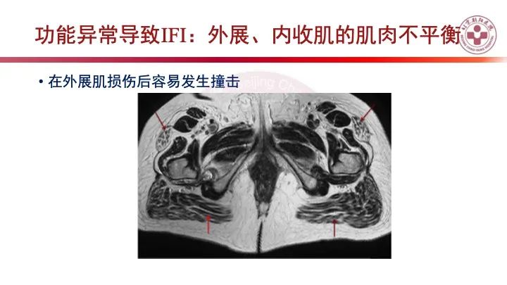 影像PPT - 【PPT】股骨坐骨撞击综合征（IFIS）-33