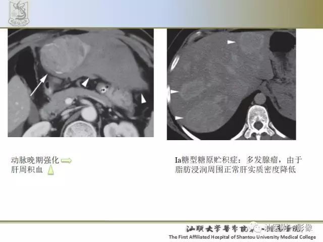 影像PPT - 【PPT】肝脏良性肿瘤或肿瘤样病变-6