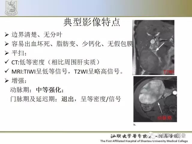 影像PPT - 【PPT】肝脏良性肿瘤或肿瘤样病变-4