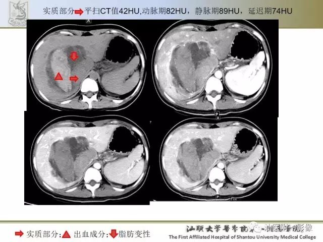 影像PPT - 【PPT】肝脏良性肿瘤或肿瘤样病变-7