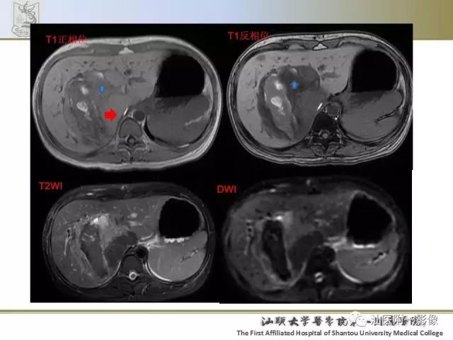 影像PPT - 【PPT】肝脏良性肿瘤或肿瘤样病变-8