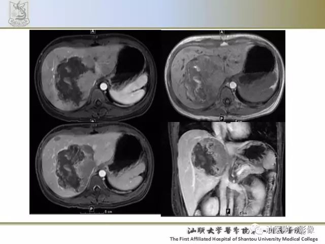 影像PPT - 【PPT】肝脏良性肿瘤或肿瘤样病变-9