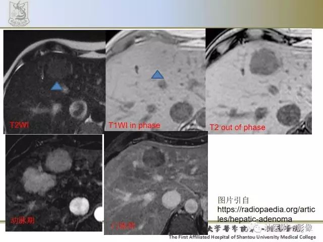 影像PPT - 【PPT】肝脏良性肿瘤或肿瘤样病变-5