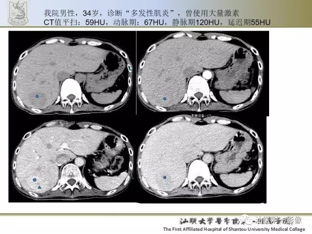 影像PPT - 【PPT】肝脏良性肿瘤或肿瘤样病变-14