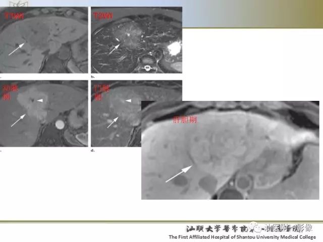 影像PPT - 【PPT】肝脏良性肿瘤或肿瘤样病变-16