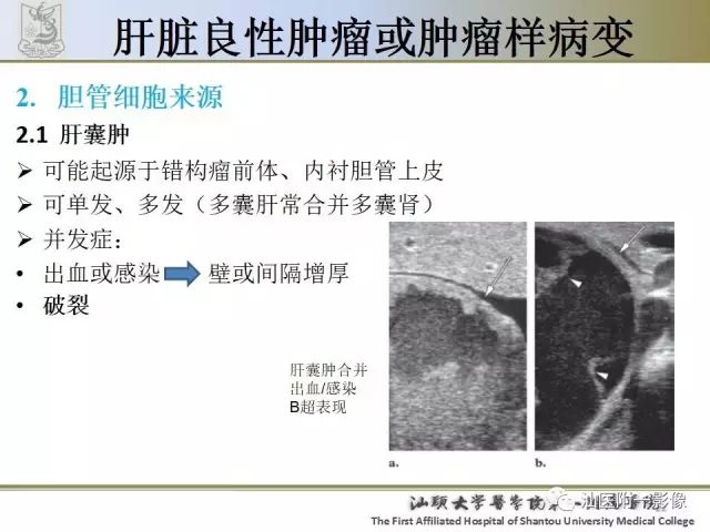 影像PPT - 【PPT】肝脏良性肿瘤或肿瘤样病变-20
