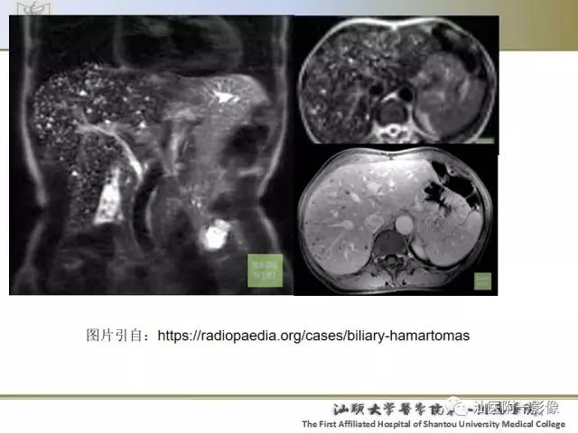 影像PPT - 【PPT】肝脏良性肿瘤或肿瘤样病变-22
