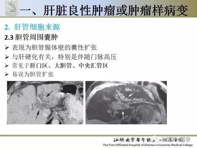 影像PPT - 【PPT】肝脏良性肿瘤或肿瘤样病变-23
