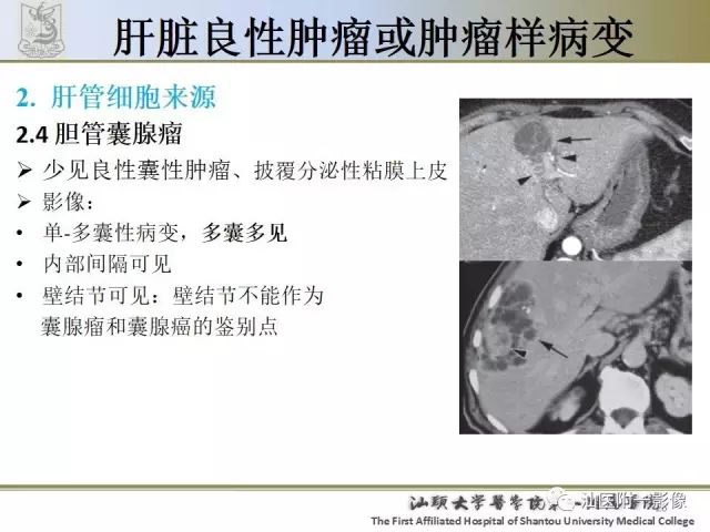 影像PPT - 【PPT】肝脏良性肿瘤或肿瘤样病变-24