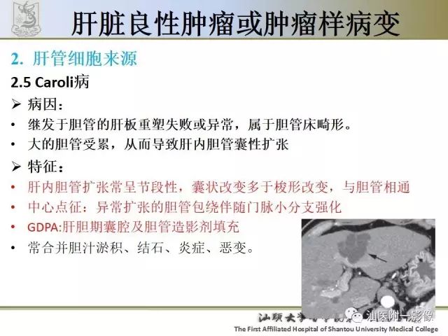影像PPT - 【PPT】肝脏良性肿瘤或肿瘤样病变-26
