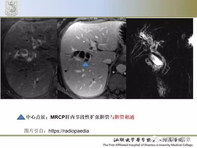 影像PPT - 【PPT】肝脏良性肿瘤或肿瘤样病变-27