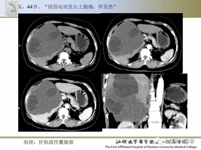 影像PPT - 【PPT】肝脏良性肿瘤或肿瘤样病变-25
