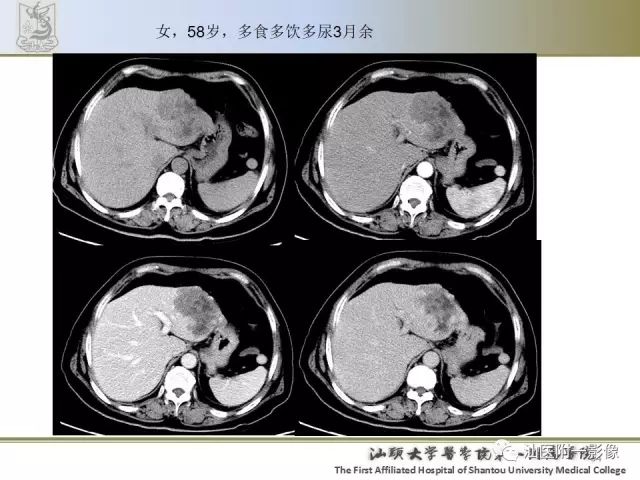 影像PPT - 【PPT】肝脏良性肿瘤或肿瘤样病变-32