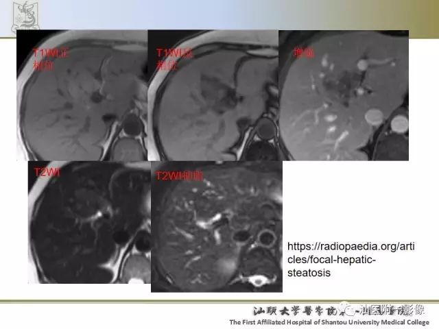 影像PPT - 【PPT】肝脏良性肿瘤或肿瘤样病变-34