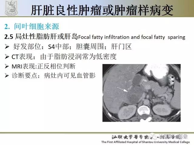 影像PPT - 【PPT】肝脏良性肿瘤或肿瘤样病变-33