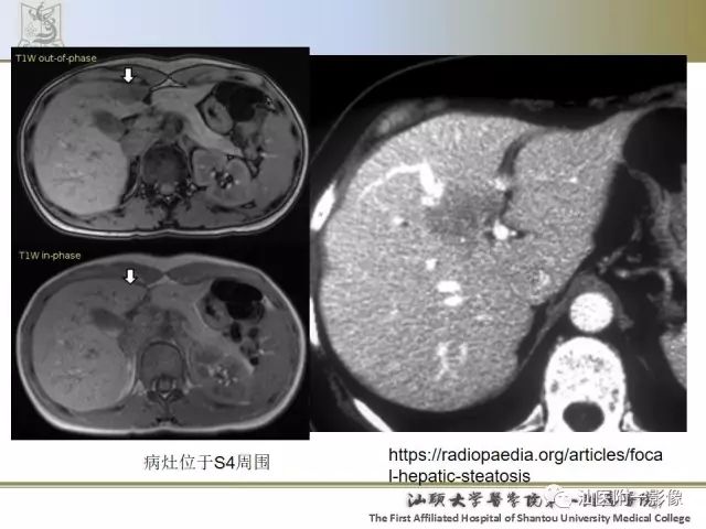 影像PPT - 【PPT】肝脏良性肿瘤或肿瘤样病变-35