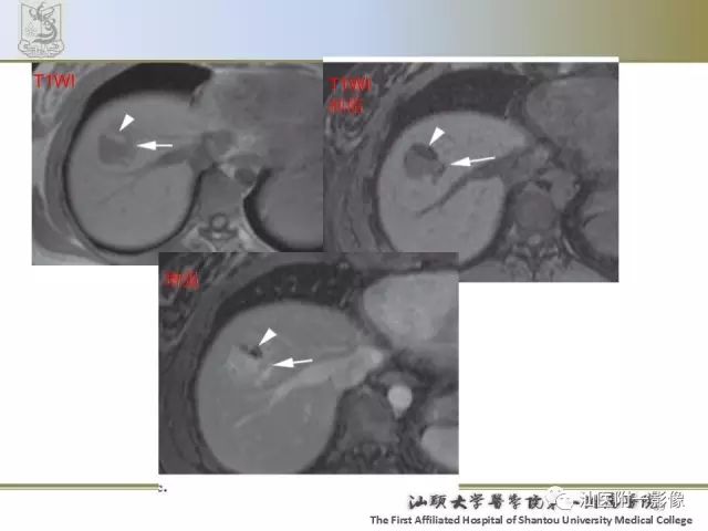 影像PPT - 【PPT】肝脏良性肿瘤或肿瘤样病变-37