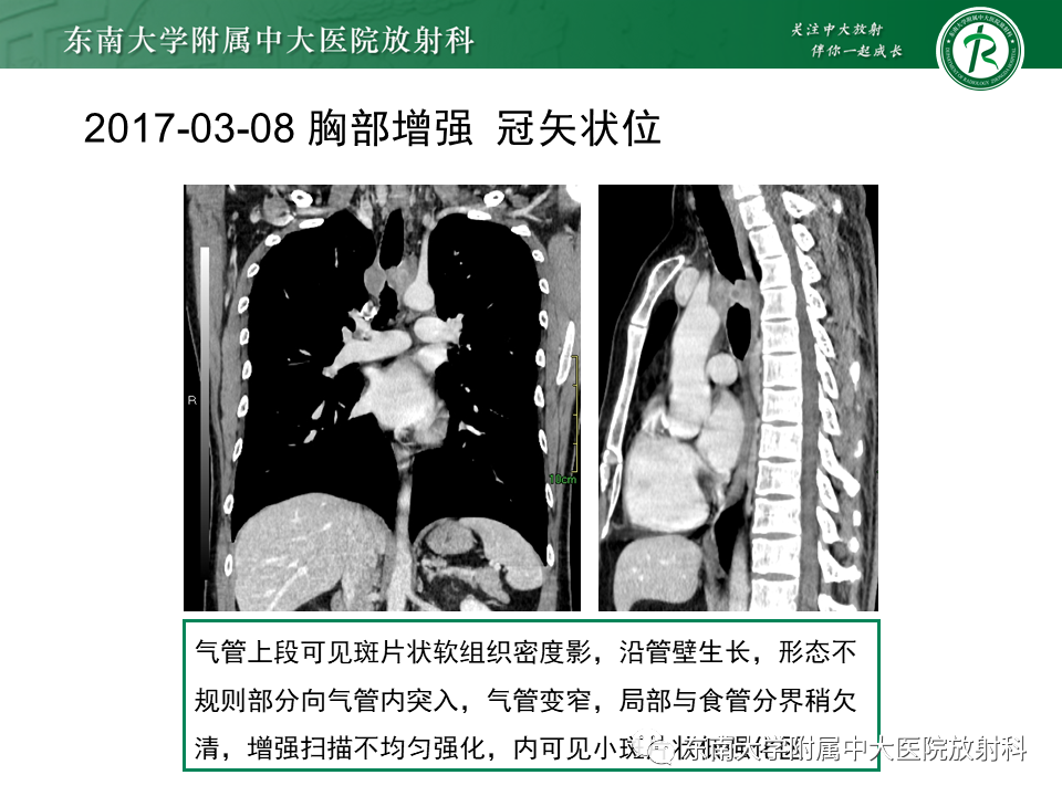 影像PPT - 【PPT】气管腺样囊性癌-3