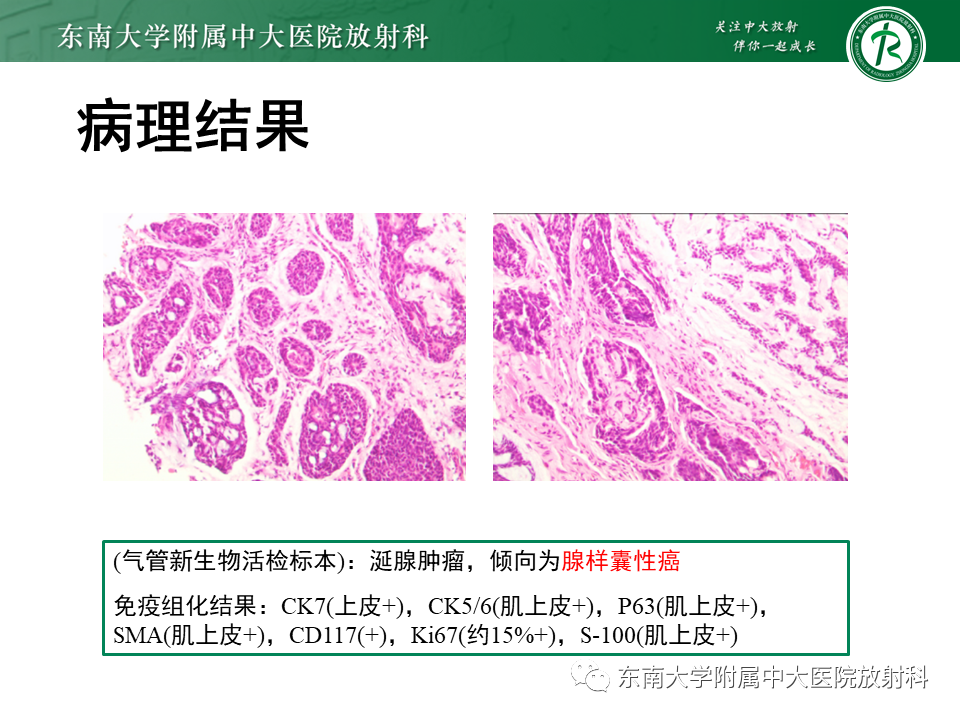 影像PPT - 【PPT】气管腺样囊性癌-4