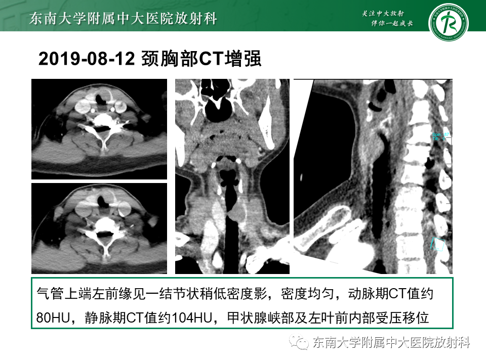 影像PPT - 【PPT】气管腺样囊性癌-6