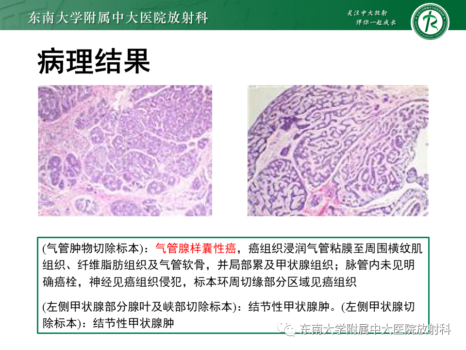 影像PPT - 【PPT】气管腺样囊性癌-7