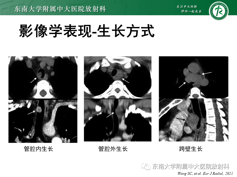 影像PPT - 【PPT】气管腺样囊性癌-14